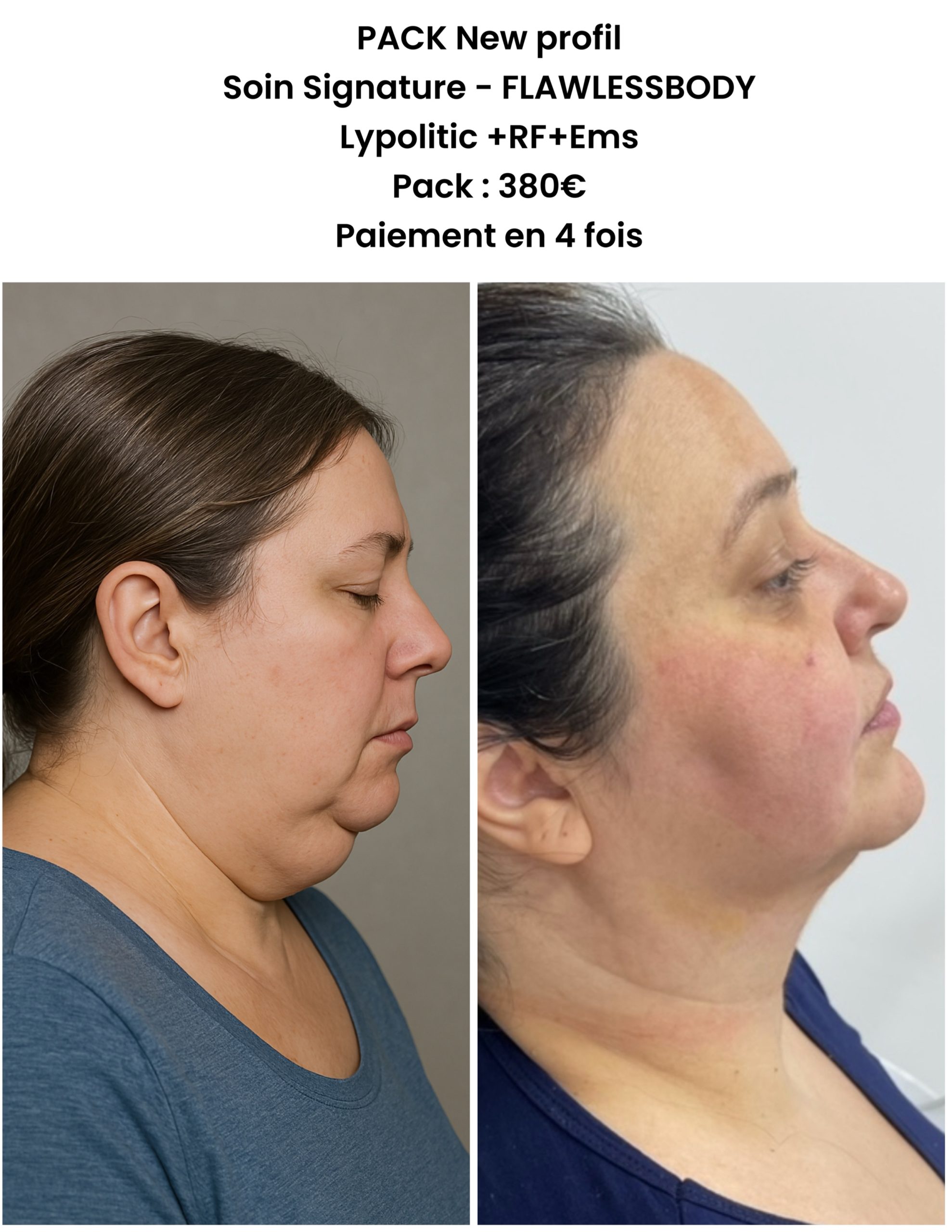 Soin Signature FLAWLESSBODY  – New Face Pack 4 Séances