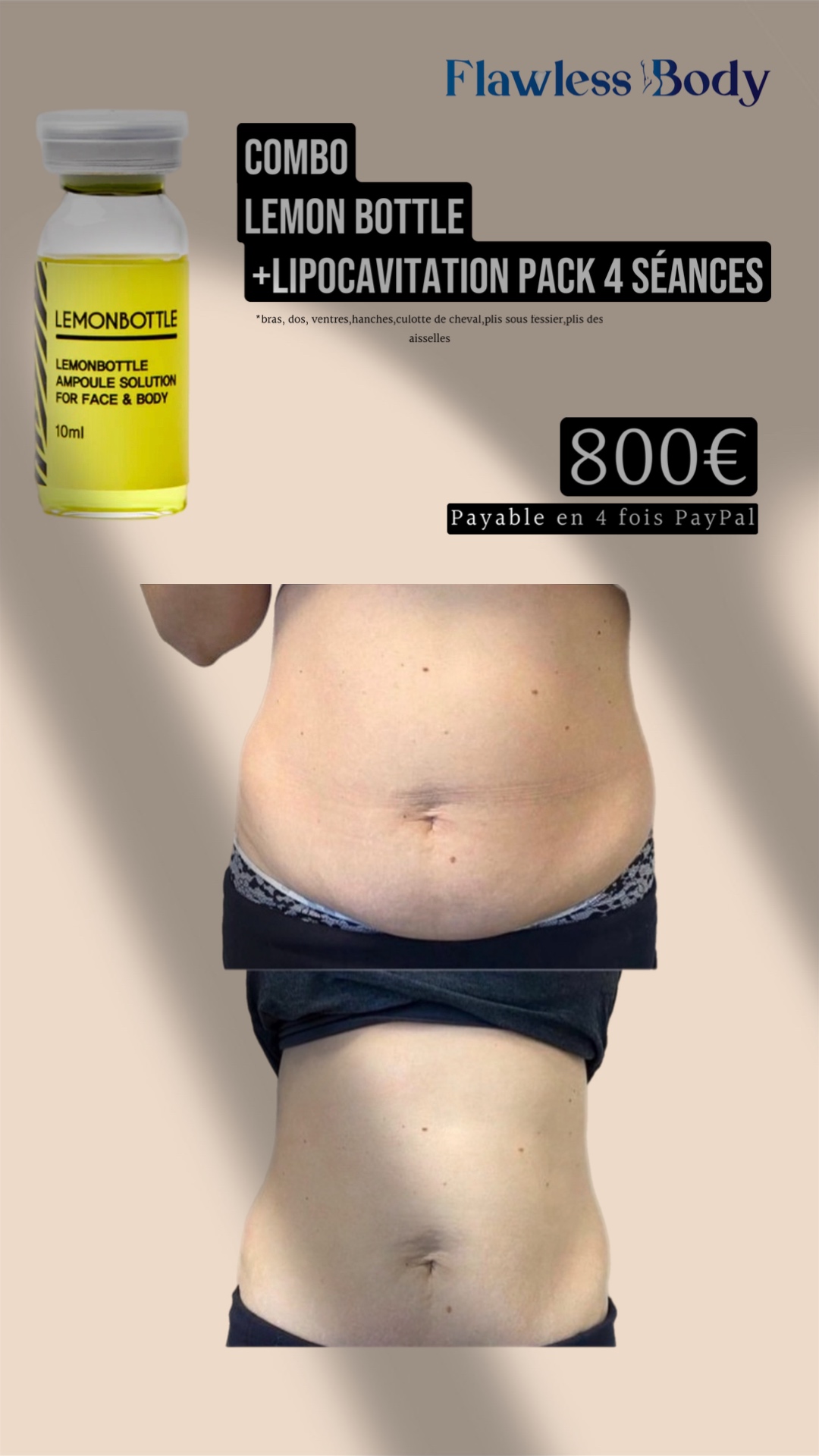 Lemon Bottle + Lipocavitation  Pack 4 Séances – Corps